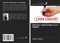 Capa do livro de Antenas implantadas en el hígado 