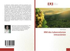 Copertina di IRM des tuberculomes intracrânien