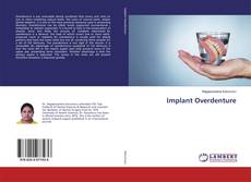 Couverture de Implant Overdenture