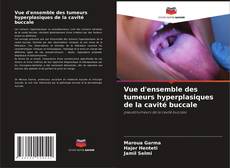 Bookcover of Vue d'ensemble des tumeurs hyperplasiques de la cavité buccale