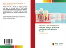 Portada del libro de O uso de guia cirúrgico na instalação de implantes dentais