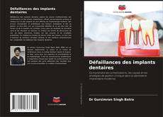 Bookcover of Défaillances des implants dentaires