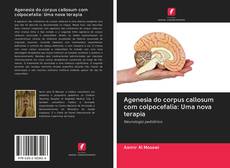 Buchcover von Agenesia do corpus callosum com colpocefalia: Uma nova terapia