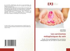Buchcover von Les carcinomes métaplasiques du sein