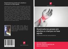 Bookcover of Queimaduras graves em adultos e crianças na fase aguda