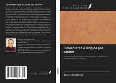 Bookcover of Escleroterapia dirigida por catéter