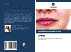 Portada del libro de Akne: