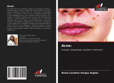 Portada del libro de Acne: