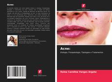 Capa do livro de Acne: 