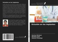 Copertina di Oclusión en los implantes