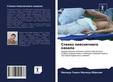 Couverture de Стеноз поясничного канала