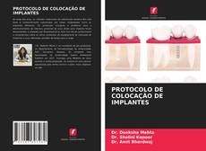 Couverture de PROTOCOLO DE COLOCAÇÃO DE IMPLANTES