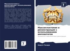 Capa do livro de Максиллэктомия и реконструкция с использованием имплантатов 