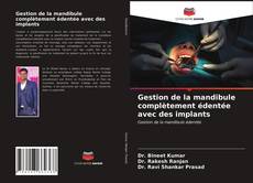 Copertina di Gestion de la mandibule complètement édentée avec des implants