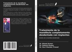 Capa do livro de Tratamiento de la mandíbula completamente desdentada con implantes 