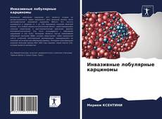 Copertina di Инвазивные лобулярные карциномы