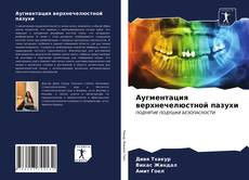 Bookcover of Аугментация верхнечелюстной пазухи