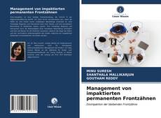 Bookcover of Management von impaktierten permanenten Frontzähnen