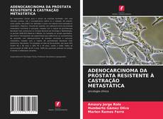 Couverture de ADENOCARCINOMA DA PRÓSTATA RESISTENTE À CASTRAÇÃO METASTÁTICA