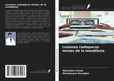 Buchcover von Lesiones radiopacas mixtas de la mandíbula