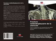 Обложка Fracture médiodiaphysaire de la clavicule