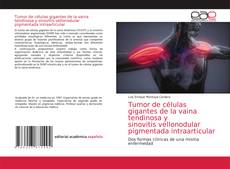 Tumor de células gigantes de la vaina tendinosa y sinovitis vellonodular pigmentada intraarticular的封面