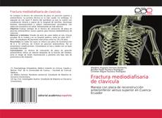 Bookcover of Fractura mediodiafisaria de clavícula
