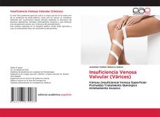 Buchcover von Insuficiencia Venosa Valvular (Várices)
