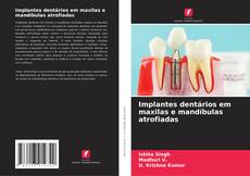 Implantes dentários em maxilas e mandíbulas atrofiadas kitap kapağı