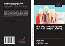 Copertina di Implanty stomatologiczne w zaniku szczęki i żuchwy