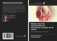 Bookcover of Edema macular relacionado con oclusiones venosas de la retina