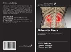 Copertina di Nefropatía lúpica
