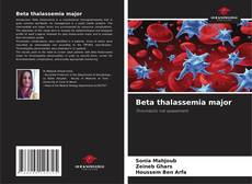 Beta thalassemia major的封面