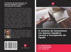 Capa do livro de O sistema de hemostasia em doença hepática normal e transplante de fígado 
