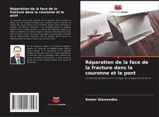 Réparation de la face de la fracture dans la couronne et le pont的封面