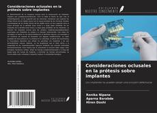 Couverture de Consideraciones oclusales en la prótesis sobre implantes