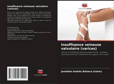Insuffisance veineuse valvulaire (varices)的封面