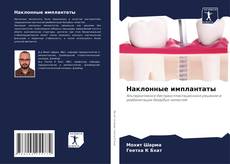 Обложка Наклонные имплантаты