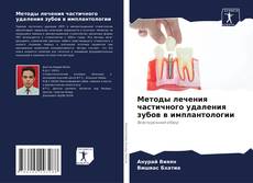 Buchcover von Методы лечения частичного удаления зубов в имплантологии