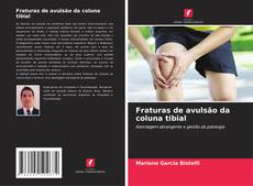 Bookcover of Fraturas de avulsão da coluna tibial