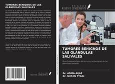 Bookcover of TUMORES BENIGNOS DE LAS GLÁNDULAS SALIVALES