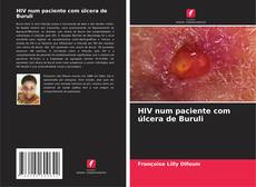 Buchcover von HIV num paciente com úlcera de Buruli