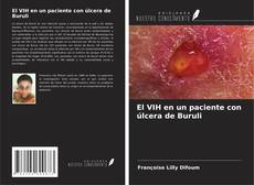 Bookcover of El VIH en un paciente con úlcera de Buruli