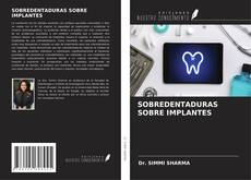 Bookcover of SOBREDENTADURAS SOBRE IMPLANTES