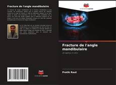 Fracture de l'angle mandibulaire kitap kapağı