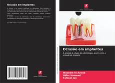 Capa do livro de Oclusão em implantes 