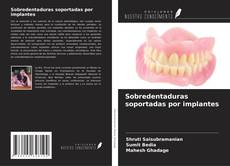 Bookcover of Sobredentaduras soportadas por implantes