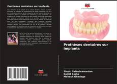Buchcover von Prothèses dentaires sur implants