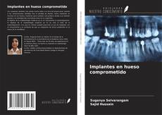 Bookcover of Implantes en hueso comprometido