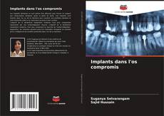 Couverture de Implants dans l'os compromis
